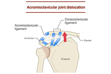 Understanding AC Joint Dislocations